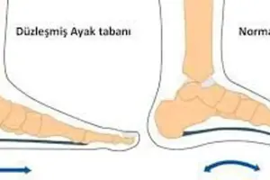 DÜZ TABAN OLMAK POLİS OLMAYA ENGEL MİDİR?